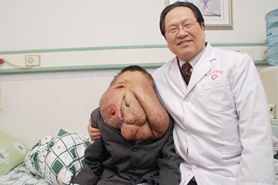 
                                    
                                    
                                    2007'de ameliyat olan ve suratından 1.5 kg'dan fazla tümör alınan Chuncai'ye bugünlerde ülkesindeki talk showlara çıkması için teklif yağıyor. Dışarı çıkmak istemediğini belirten 39 yaşındaki adamın en büyük isteği bir an önce sağlığına kavuşmak.

                                
                                
                                