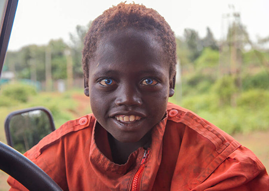 "Waardenburg Sendromu" nedir?
Hem klinik hem genetik olarak oldukça değişken özellikleriyle ortaya çıkan işitsel pigmenter sendromlardan birisidir. Kişilerde işitme kaybı, gözlerde, saçta ve deride pigmentasyon bozukluklarıyla kendini gösterir.