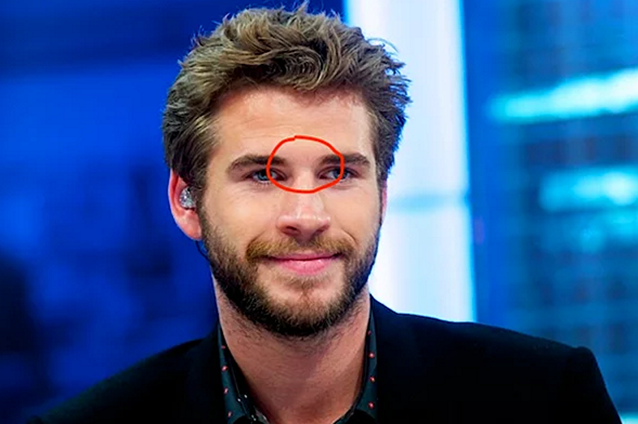 Glabella

                                    Kaşlarımızın arasında kalan bölgeye Glabella adı verilir. Tıpta bu terimin açıklaması Alın kemiğinin iki kaş çıkıntısı arasında kalan kısmında bulunan ve antropolojide önemi olan hafif bir kabartı, kaşarası, kaşlararası tümseğine verilen addır.

Kaynaklar: tkbbv.org. , wikipedia, haberler.com, tipterimlerisozlugu.com
                                