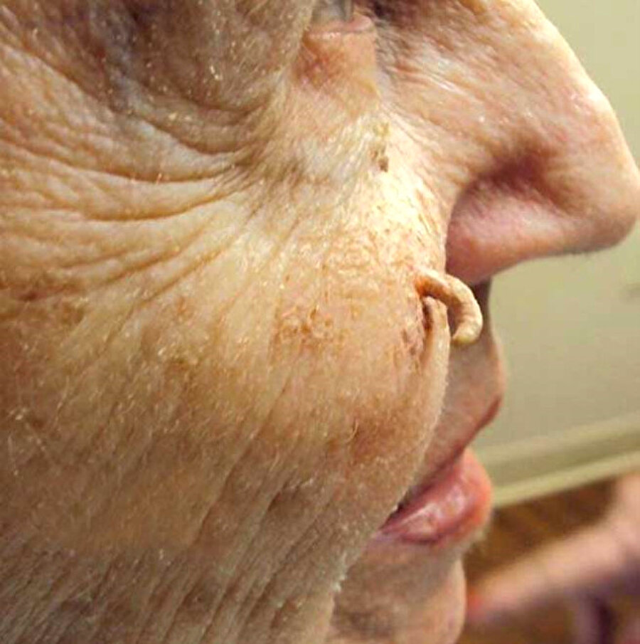 Rhinophyma hastaları da geliyor
Hastaların arasında "Rhinophyma" rahatsızlığına sahip kişiler de bulunuyor. Bu hastalık; burundaki derinin incelmesi ve üretilen yağ miktarının artmasıyla oluşan siyah noktalara sebep oluyor.