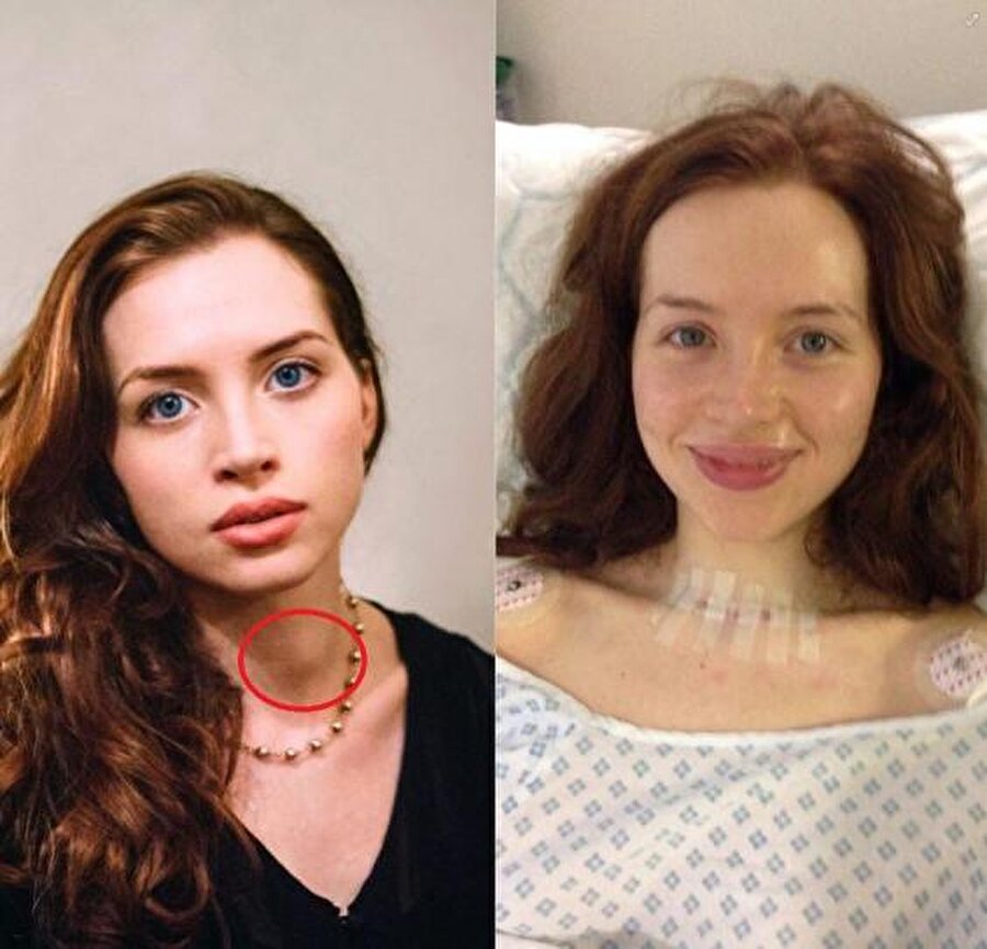 Belirtileri önemsemek gerekiyor
Lorna Nickson Brown, "Annem fotoğrafıma baktığında boynumun sol tarafında bir şişlik fark etmiş. İkimiz de bu durumu verdiğim kilolara bağladık. Üç ay sonra hastaneye gittiğimde tiroid kanseri olduğum ortaya çıktı" dedi.