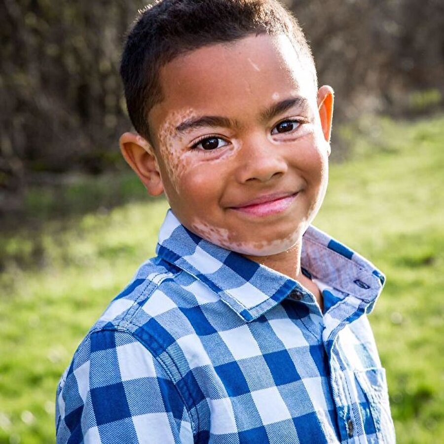 8 yaşındaki Carter Blanchard, cilt pigmenti olan melanin eksikliğinden kaynaklanan vitiligo rahatsızlığına yakalandı. Carter'ın gözlerinin etrafından oluşan beyaz lekeler çocuğun kendine olan güvenini azalttı.