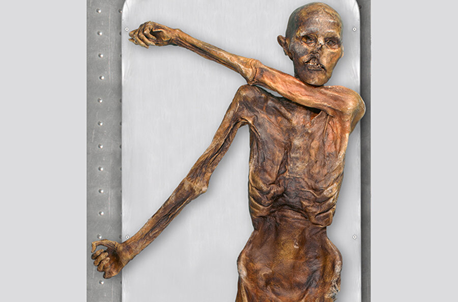 20 yıl diş ağrısı çekmiş
2013 yılında yapılan bir başka araştırmada ise Ötzi'nin hayatının 20 yılında ciddi diş ağrılarıyla mücadele ettiğini ortaya çıkarmıştır. 