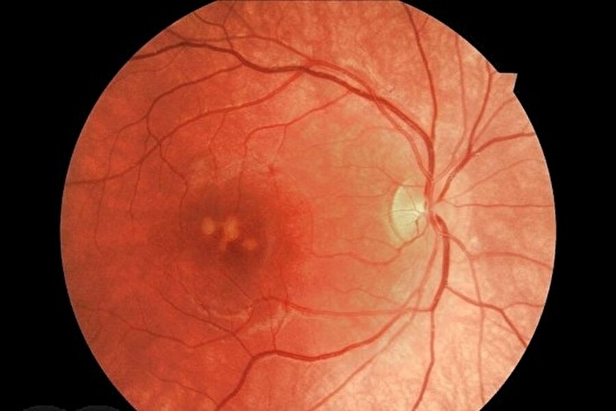 Retinada görme kaybı
Retinanın hemen arkasında, maküler olarak adlandırılan bölgede yanma yüzünden görme kaybı meydana geldi. 
