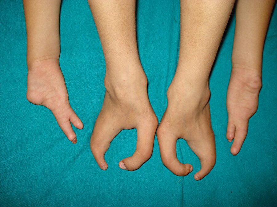 Ektrodaktili 
Ektrodaktili, el ve ayaklarda görülen şekil bozukluğudur.
