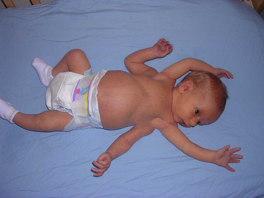 Polymelia
Polymelia, dünyaya gelen bebeğin normalden fazla kol ve bacaklara sahip olma halidir.