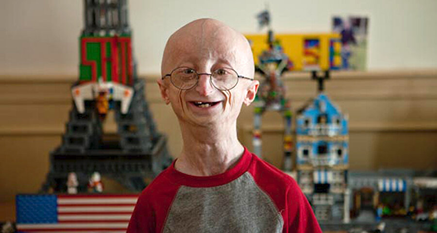 Progeria
Progeria, halk arasında ‘erken yaşlanma hastalığı’ olarak bilinir.