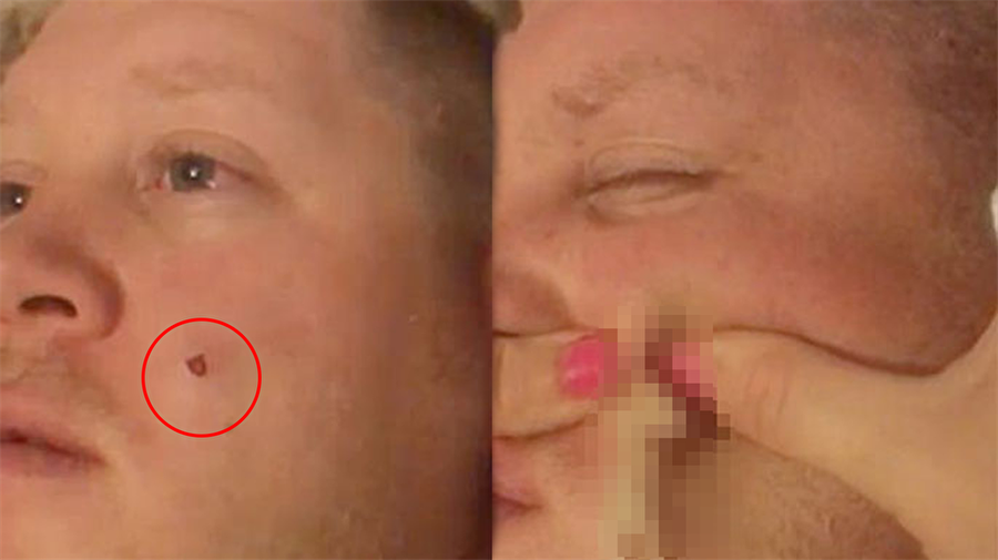 Yıllardır var olan sivilcesini sıktı, içinden çıkanlar şoke etti