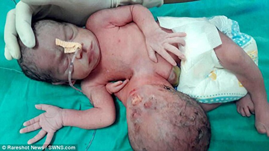 
                                    Doktorlar, doğumun ardından aileye bebeğin durumunun kritik olduğunu ve acilen operasyona alınmazsa ölebileceğini belirtti.
                                