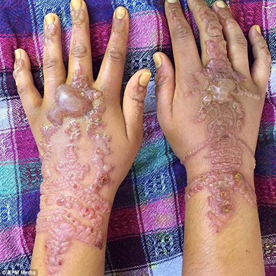 Geçici dövme nedeniyle genç kadının cildi alerjik reaksiyon gösterdi. 