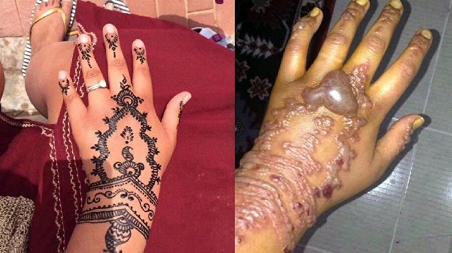 Genç kadın tatil sırasında ellerine geçici dövme yaptırdı. 