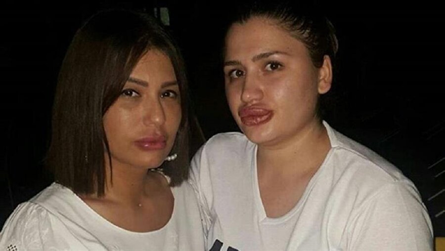 Dudak silikonu faciasında flaş gelişme