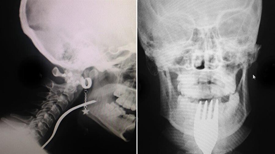 boğazına çatal girdi