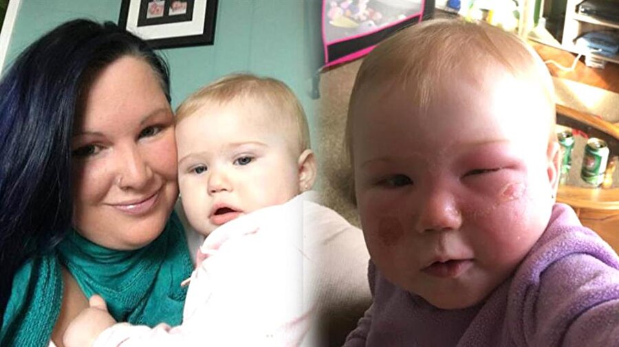 Bir annenin ihmalkarlığı bebeğin suratını bu hale getirdi