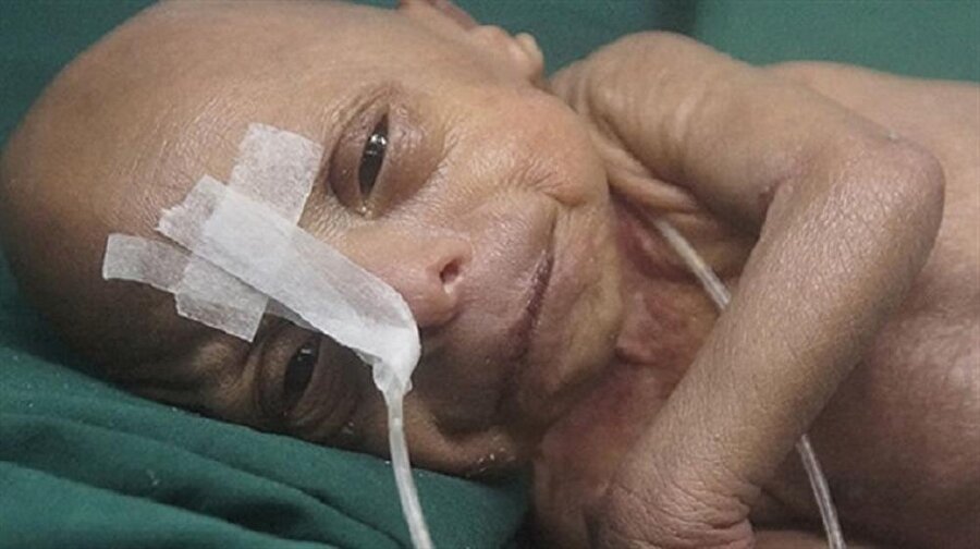 Benjamin Button filmi gerçek oldu!
