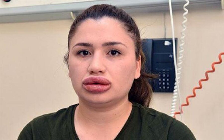 Silikon mağduru hemşire sosyal medyadan son halini paylaştı