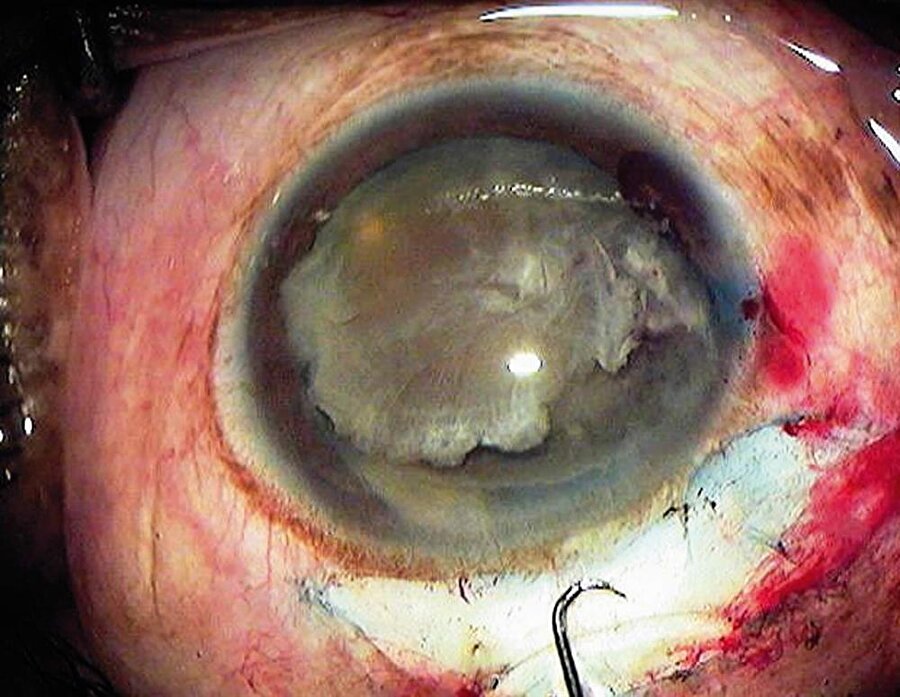 İşte o ilginç görüntü!

                                    Doktorlar, bir balıkçı kancasını çıkardıkları göz küresinin korkunç anını kameraya çekti.Gözün merkezine sıkışan kanca, doktorlar tarafından özenle çıkartıldı.
                                