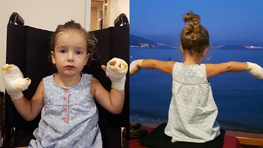 Bursa'da seyyar satıcıdan alınan balon yüksek sesle bomba gibi patlayarak, 3 yaşındaki Mira'nın ellerini yaktı.