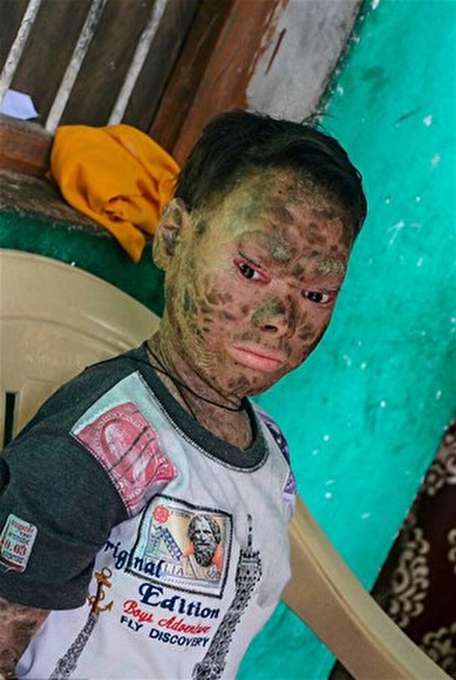 Hindistan'da yaşayan 16 yaşındaki Shalini Yadav isimli genç kız, 'eritroderma' denen hastalığın en ileri safhalarına gelmiş durumda. 'Yılan kız' olarak anılan kız, insan içine çıkamıyordu.

                                    
                                    
                                    
                                    
                                    
                                    
                                    
                                
                                
                                
                                
                                
                                
                                