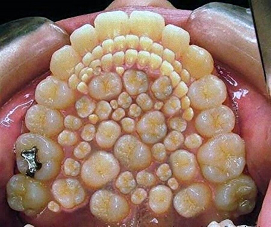 Şiddetli ağrı şikayetiyle diş hekimine giden Hindistanlı gencin ağzından 6 saat süren operasyonla 232 diş çıkarıldı.

                                    
                                    
                                    
                                    
                                    
                                    
                                    
                                
                                
                                
                                
                                
                                
                                