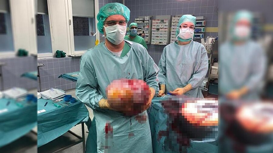 Kadın hastanın karnından 10.2 kilogram tümör çıkartıldı 