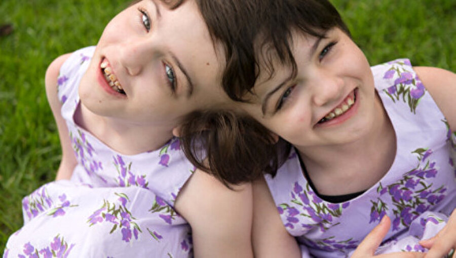 Ameliyat edilemiyor

                                    Birbirlerinin gözünden bakabilen ikizler, beyinleri birbirine yapışık olduğu için ameliyat edilemiyor.
                                