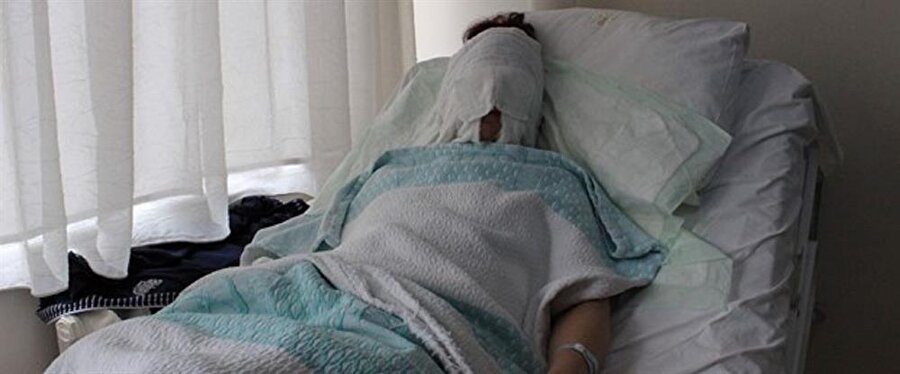 Tartıştığı erkek arkadaşı yüzüne kimyasal madde attı.