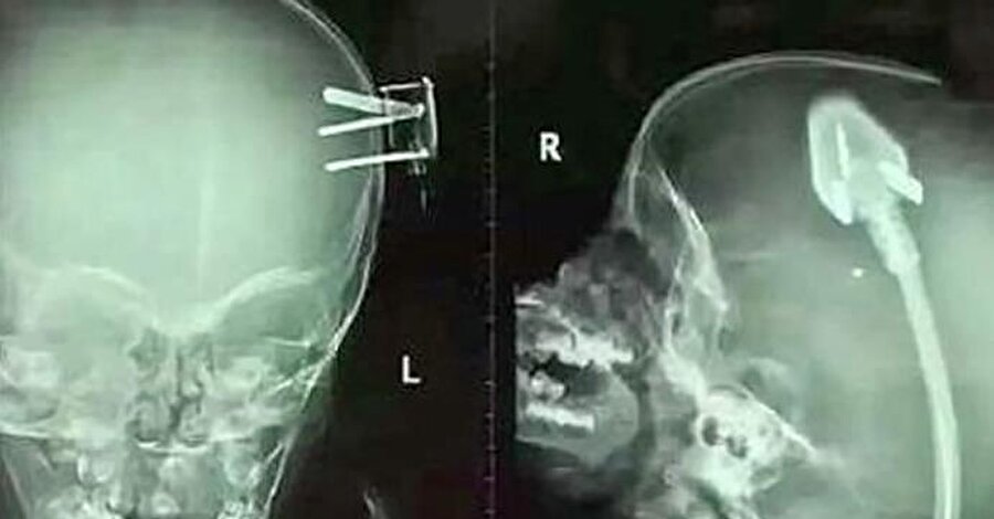 Aile şoke oldu!

                                    2 yaşındaki çocuklarının röntgen sonucunu gören aile, çocuklarını acilen hastaneye götürdü.
                                