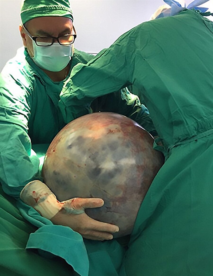Diğer organlarını ezdi!
Kosta Rika'da yaşayan 57 yaşındaki Sonia Lopez, 'kişisel nedenlerden ötürü' sekiz yıl süreyle tümörden kurtulmak için ameliyatını erteledi. Sonunda tümör karnının yüzde 80'ini kapladı ve bağırsaklarını, karaciğeri ve diğer organlarını ezdi. 