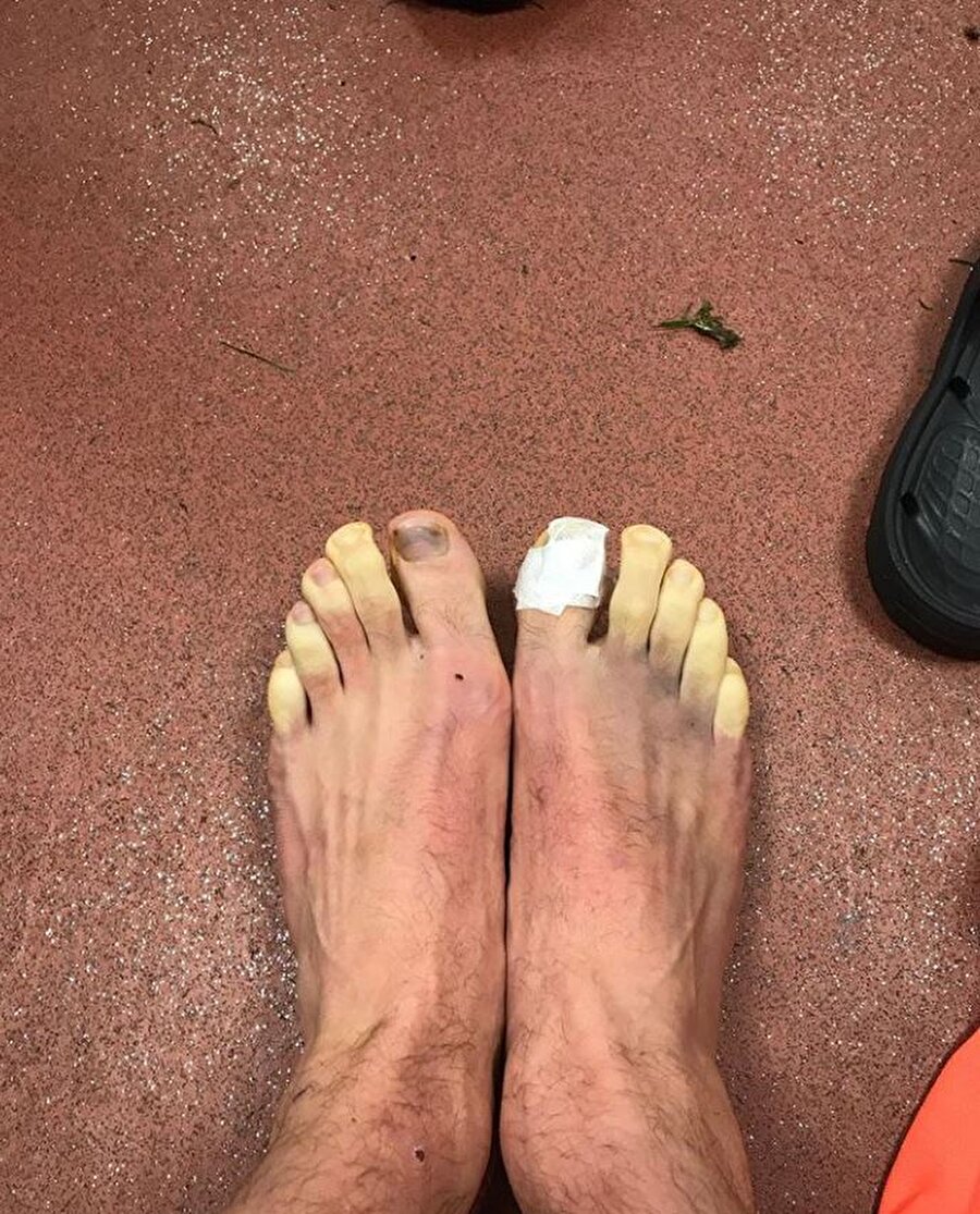 Yıldız futbolcunun ayakları bu hale geldi!