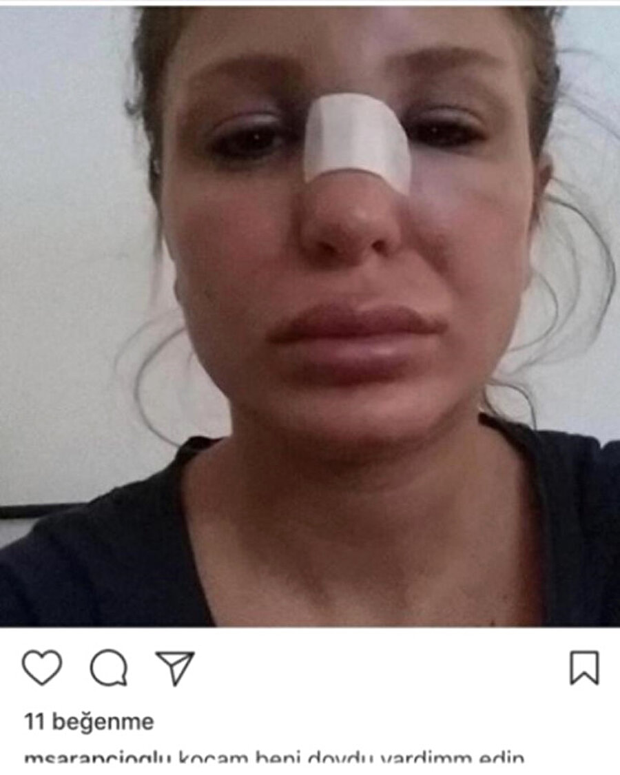 Merve Şarapçıoğlu'nun telefonunun hacklendiği ve fotoğrafın estetik operasyon sonrası çekildiği ortaya çıktı.