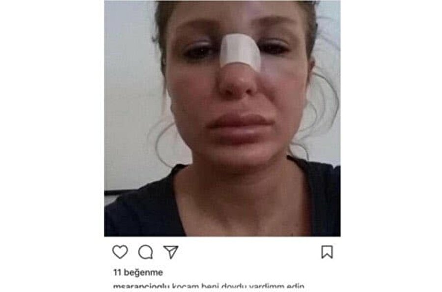 "Kocam beni dövdü. Yardım edin"
Şarapçıoğlu'nun sosyal medya hesabından yapılan bu paylaşımın altına "Kocam beni dövdü. Yardım edin" yazıldı. Paylaşım dakikalar sonra silinirken, hesabın hacklenip hacklenmediği ya da fotoğraftaki kişinin o olup olmadığı henüz netlik kazanmadı.