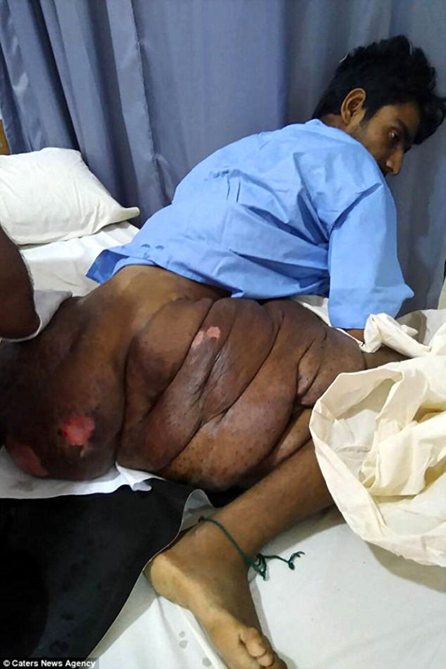 Pakistan'ın Karaçi kentinde yaşayan Pallari, geçtiğimiz çarşamba günü sağ bacağındaki tümörden kurtulmak için Dr. Ruth Pfau hastanesine yattı. Pallari'nin sağ bacağındaki devasa tümör, 4 saatlik bir ameliyatla dört cerrah tarafından çıkarıldı.

                                    
                                