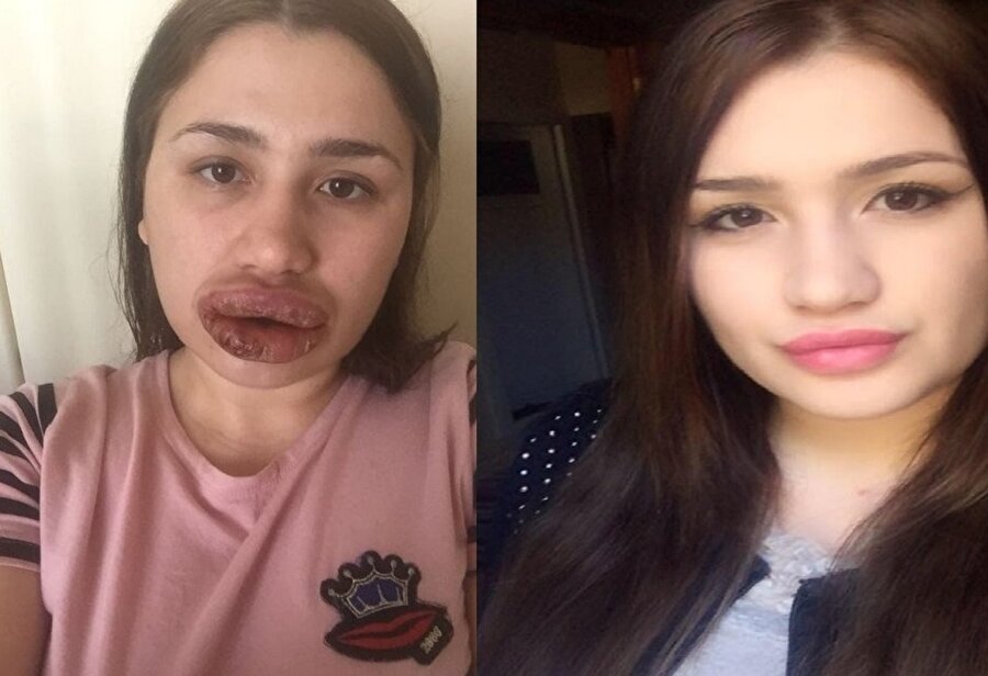 Dudaklarını kaybetme riskiyle karşı karşıya kalan hemşire Merve Keleş