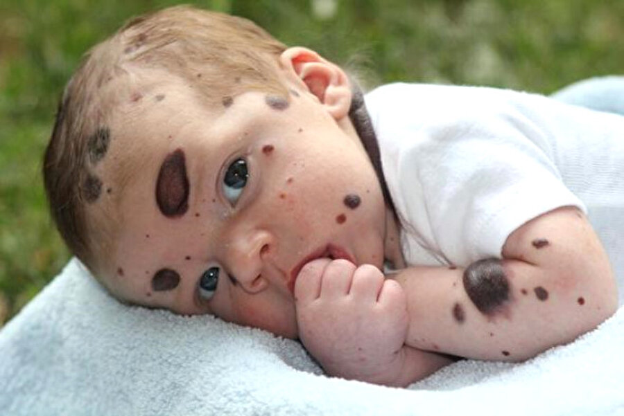 Vücudunun bir bölümü lekeyle kaplıydı

                                    
                                    
                                    
                                    Newsner'in haberine göre; bebeğe konulan konjenital melanositik nevüs tanısı nedeniyle bebeğin vücudunun % 80'i siyah lekelerle kaplıydı. 
                                
                                
                                
                                