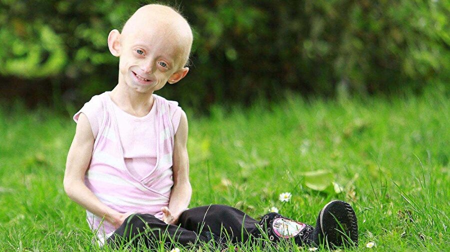 Progeria (Erken Yaşlanma Hastalığı)

                                    
                                    Halk arasında yaşlılık veya erken yaşlanma hastalığı olarak bilinen progeria, bir tür genetik hastalık. 8 milyonda 1 kişide görülen hastalık DNA’nın yapısındaki telomer zincirinin kısalmasından kaynaklanıyor. Tıp dünyasında fareler üzerinde yapılan deneylerle, gen değişimi gibi yöntemler denense de, hastalığın şu an etkili bir tedavi yöntemi bulunmuyor. Progeria hastalığının teşhisi ise oldukça kolay; saçların tamamı veya bir kısmı dökülmeye başlıyor, kel kalan kafa derisinde damarlar belirgin bir şekilde fark ediliyor.

  
Yüz ifadesi asla bir çocuğu andırmıyor ve tıpkı 70-80 yaşındaymış izlenimi veriyor. Çene ve diş yapısı az geliştiğinden, dişlerde çürükler meydana geliyor. Hastada herhangi bir zeka geriliği veya konuşma güçlüğü gözlenmiyor. Dışarıdan büyüme hormonları verilse de bunlar hiçbir işe yaramıyor ve hasta cinsel aktivitelerini sağlayacak gelişimini tamamlayamıyor. Bu hastalığa yakalanan çocukların ortalama yaşam ömrü 12-13 yıldır.
                                
                                