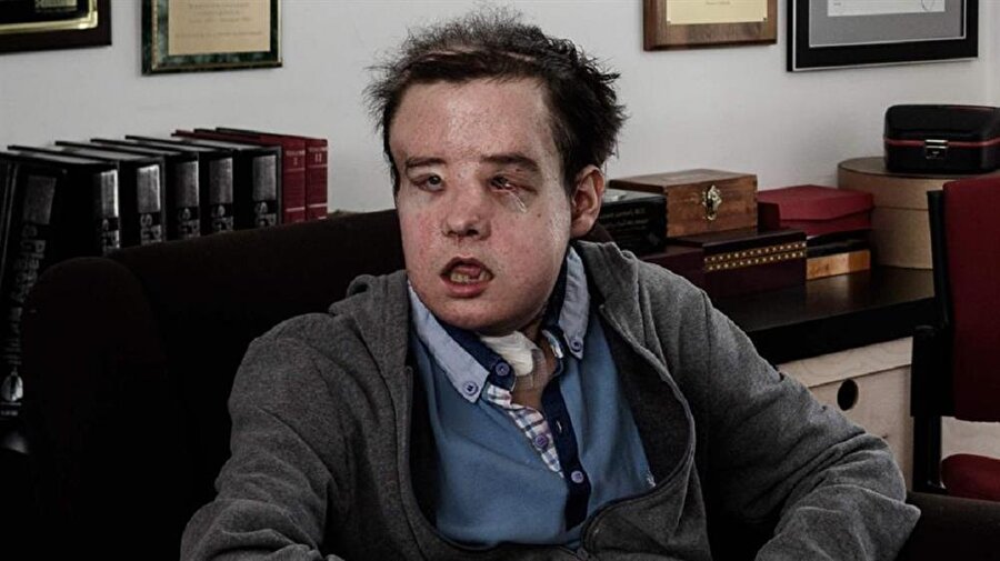 Dünyada ilk kez aynı kişiye ikinci yüz nakli yapıldı.