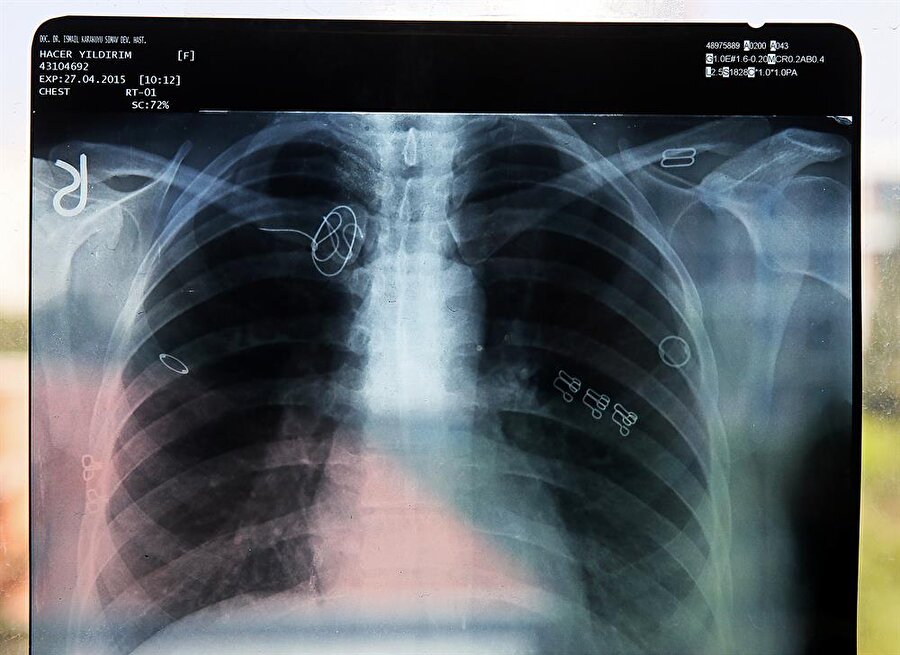 Ameliyatta vücudunda tel unutulan hastaya 30 bin lira tazminat ödenmesine karar verildi.