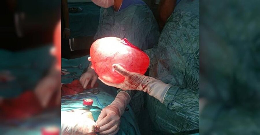 Görenler şoke oluyor! Bir insanın karnın çıkarıldı, ağırlığı 4.5 kilo