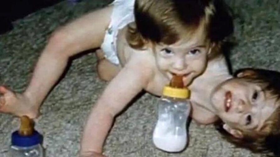 "Yaşamaz" denilen siyam ikizleri 27 yaşında!