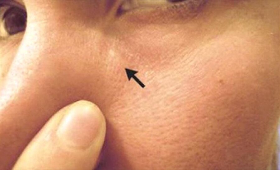 Rus kadın haftalarca yüzünde hareket eden kurt ile yaşadı!