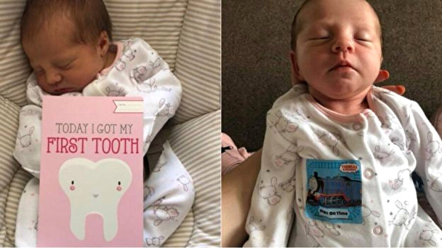 2 bin bebekte 1'i dişle doğuyor!
Jasmin, Isla-Rose'un dişi çekilirken çok cesur olduğu için kendisinin cesaret etiketiyle ödüllendirildiğini söyledi. İngiliz Diş Hekimliği Derneğinden yapılan açıklamada, her 2 bin bebekte 1 bebeğin dişle doğduğunu, kökleri uygun şekilde gelişmediği için de bu dişin genelde gevşek olduğu bildirildi. BDA Bilimsel Danışmanı Profesör Damien Walmsley, "Çok nadir görülse de, bu tür durumlar emzirme ve çocuğun dilinde yara oluşmasına yol açabilir. Ayrıca dişin çocuğun akciğerine gidebilme riski vardır" dedi.