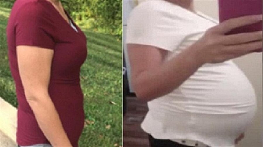 Ameliyatı kabul eden genç kadının karnından 20 kiloluk kist çıkartıldı.