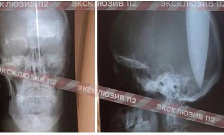 Burun tıkanıklığı yüzünden nefes alamayan adam kendi kafasını deldi.