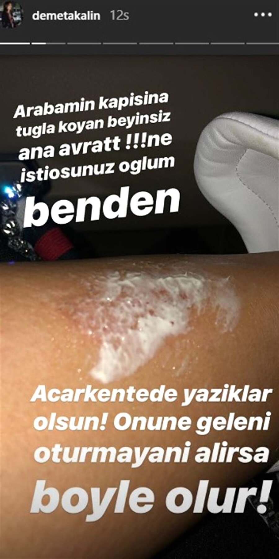 "Ne istiyorsunuz oğlum benden" 
Ünlü popçu Demet Akalın, son olarak başına gelen bir kaza sonrası sosyal medya hesabındaki tepki dolu bir paylaşımla gündem olmuştu. Arabasının yanına konulan tuğlalara bacağını çarpan ünlü şarkıcı, "Ne istiyorsunuz oğlum benden" diyerek isyan etti. 