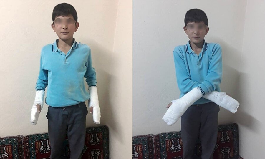 Okul müdürünün değnekle dövdüğü iddia edilen Ömer Koca'nın parmakları kırıldı.