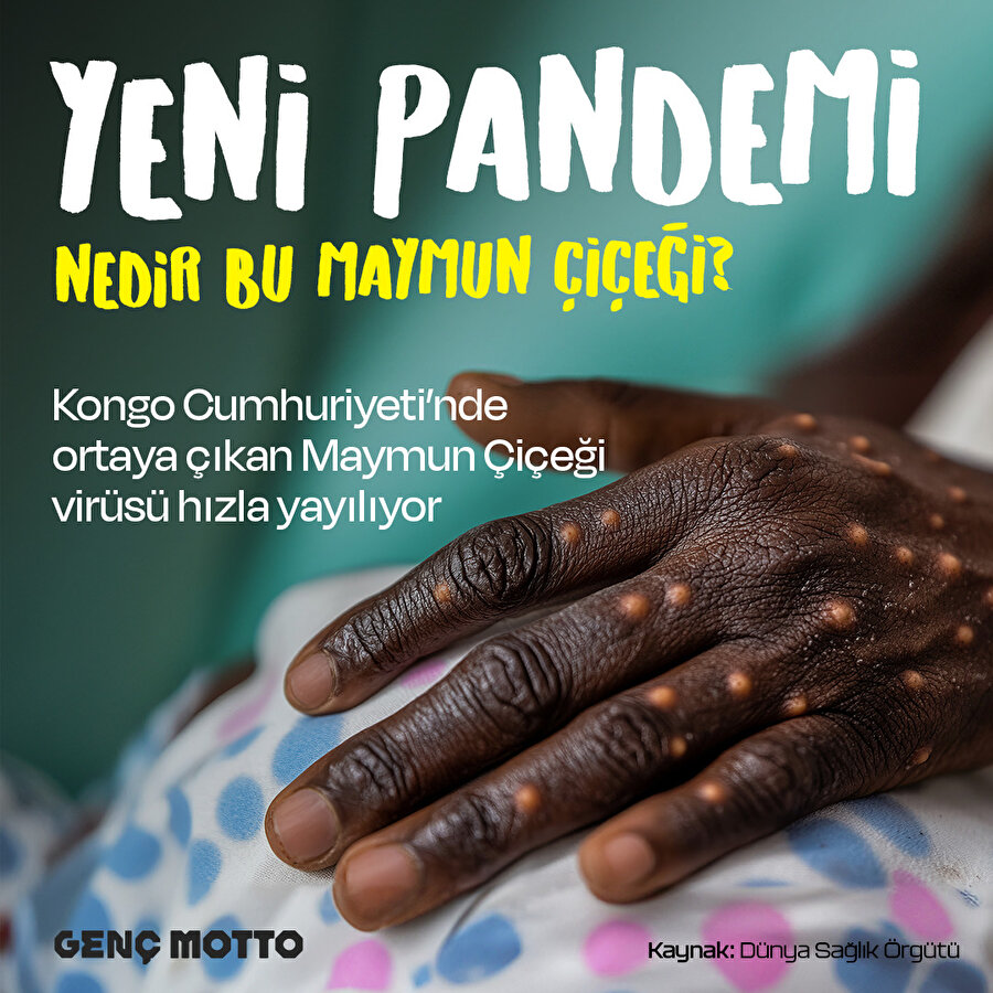 Tüm Dünya’da Maymun Çiçeği virüsü konuşuluyor 🦠