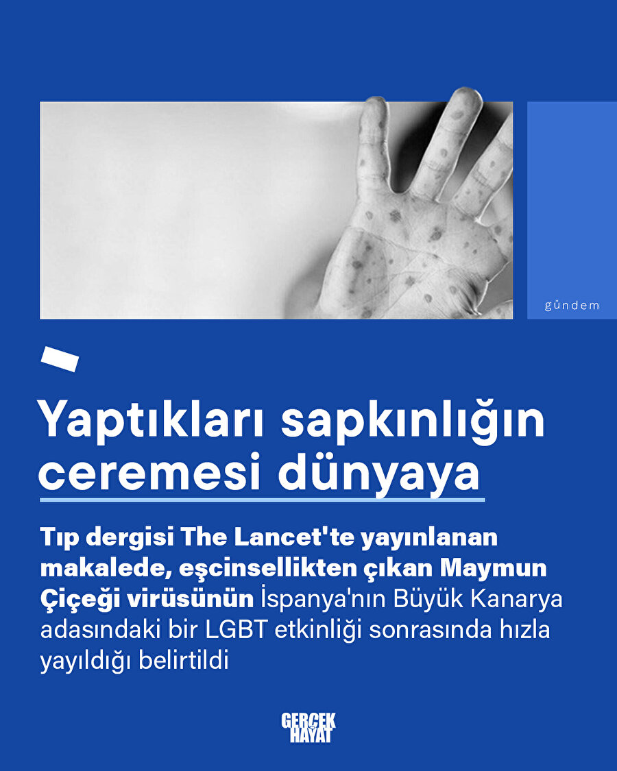 Sapkınların virüsü yayılıyor: Maymun çiçeği