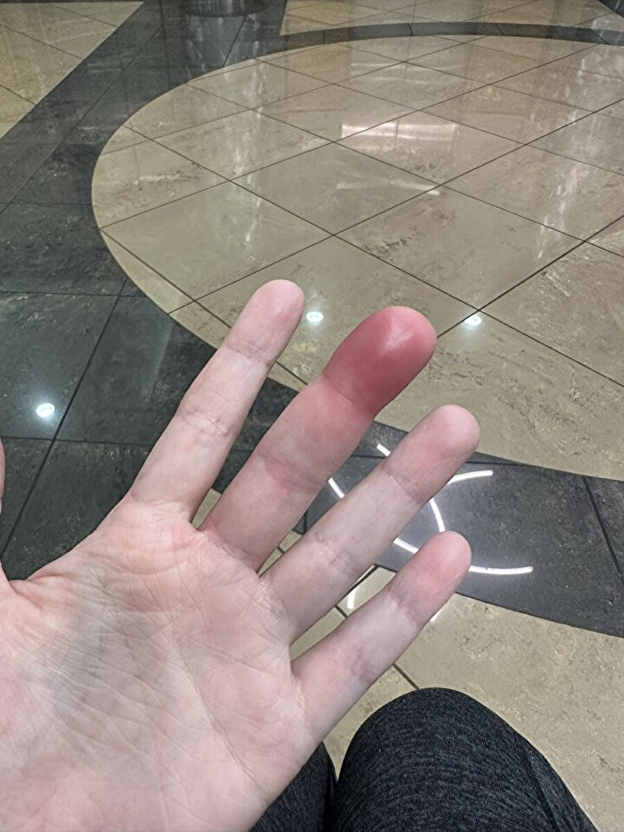 Daha önce hiç çizgi film efektiyle şişen parmak görmemiştik