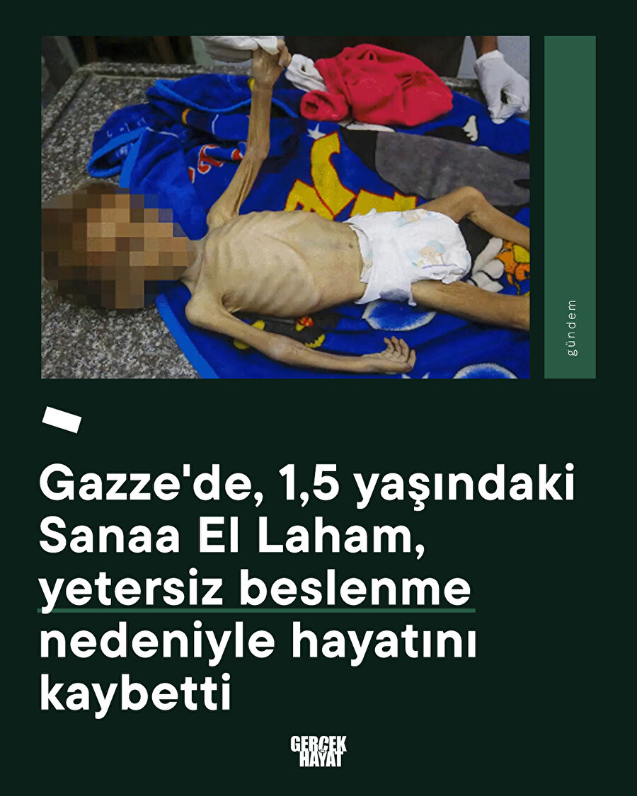 Gazze'de, 1,5 yaşındaki Sanaa, yetersiz beslenme nedeniyle hayatını kaybetti